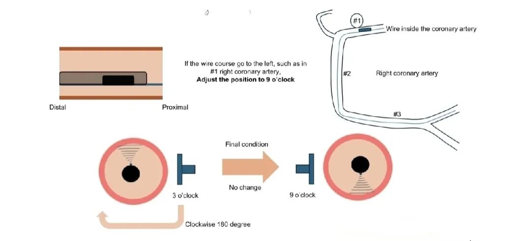 造影导丝是什么如何用“化身导丝”的理念去理解和实现 IVUS-造影配准？_https://www.jmylbn.com_新闻资讯_第13张