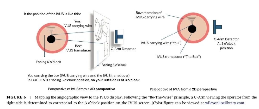 造影导丝是什么如何用“化身导丝”的理念去理解和实现 IVUS-造影配准？_https://www.jmylbn.com_新闻资讯_第11张