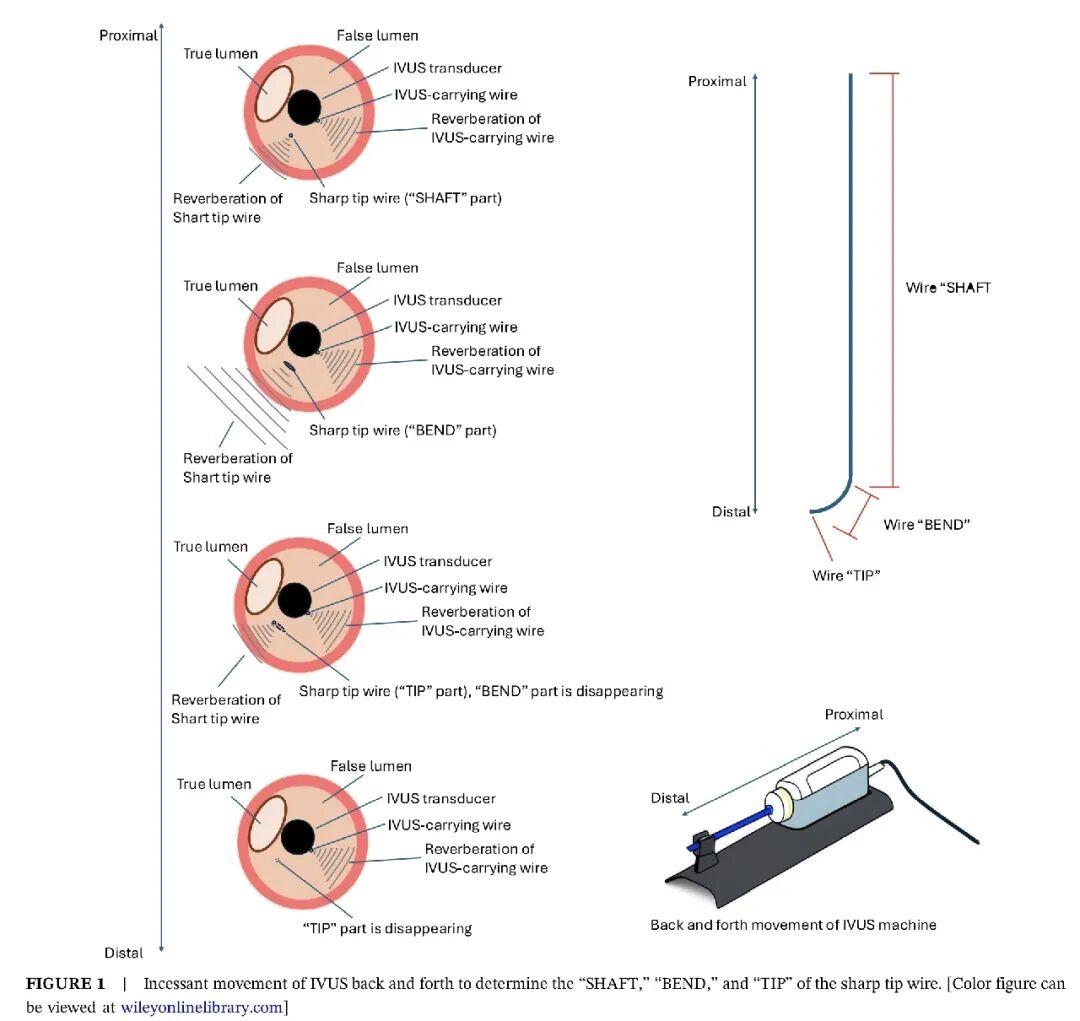 造影导丝是什么如何用“化身导丝”的理念去理解和实现 IVUS-造影配准？_https://www.jmylbn.com_新闻资讯_第2张