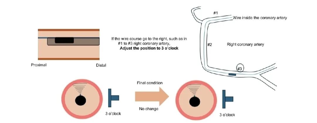 造影导丝是什么如何用“化身导丝”的理念去理解和实现 IVUS-造影配准？_https://www.jmylbn.com_新闻资讯_第14张