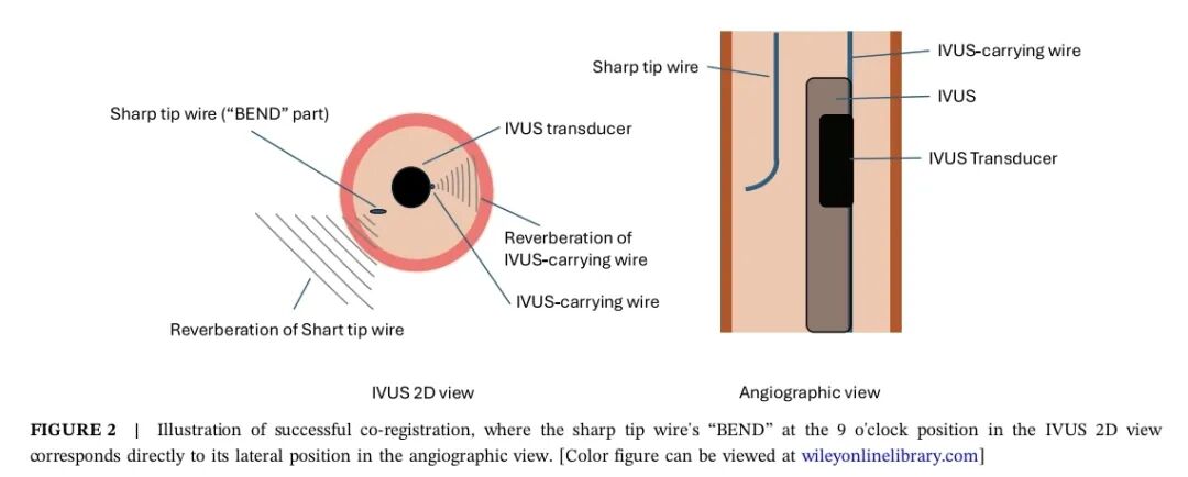 造影导丝是什么如何用“化身导丝”的理念去理解和实现 IVUS-造影配准？_https://www.jmylbn.com_新闻资讯_第3张