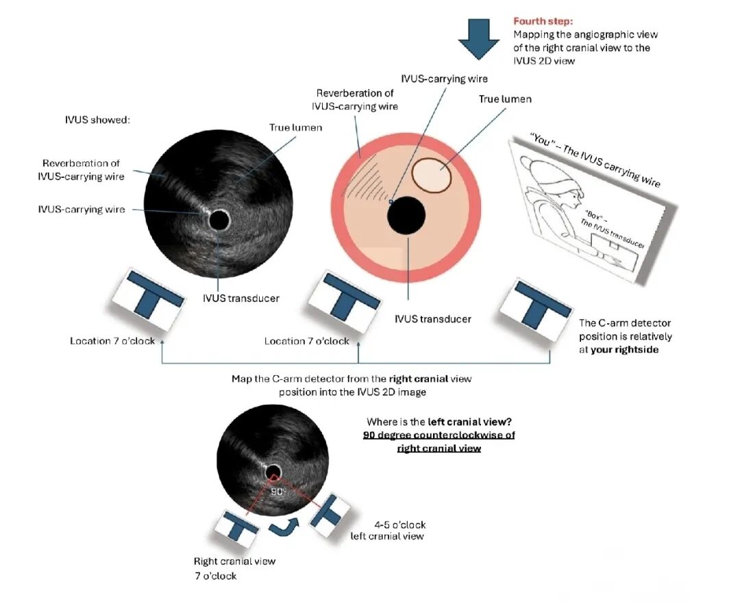 造影导丝是什么如何用“化身导丝”的理念去理解和实现 IVUS-造影配准？_https://www.jmylbn.com_新闻资讯_第17张