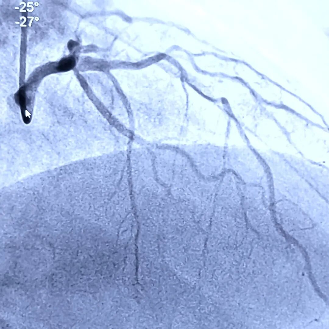 造影导丝是什么如何用“化身导丝”的理念去理解和实现 IVUS-造影配准？_https://www.jmylbn.com_新闻资讯_第21张