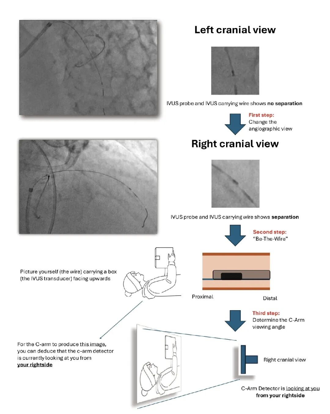 造影导丝是什么如何用“化身导丝”的理念去理解和实现 IVUS-造影配准？_https://www.jmylbn.com_新闻资讯_第16张