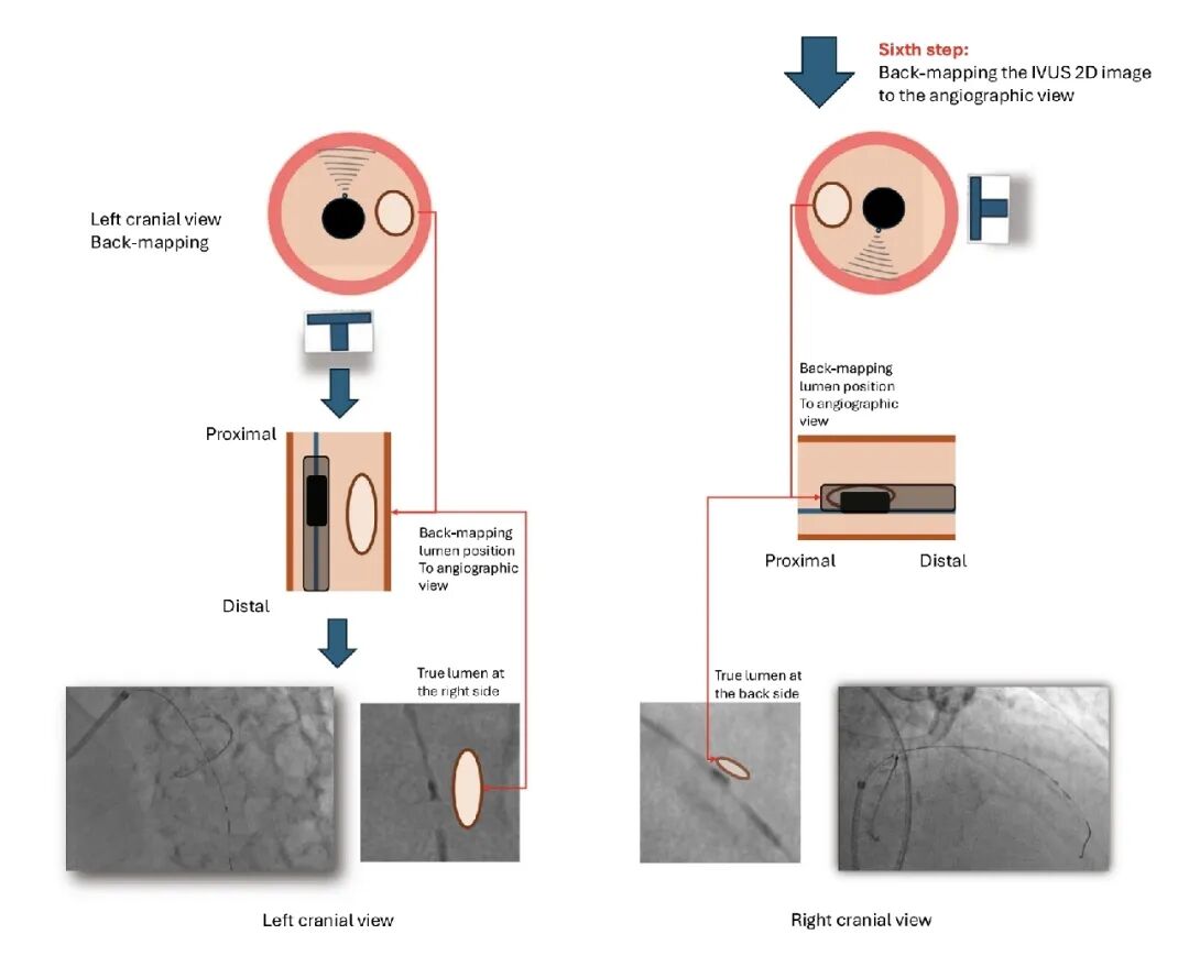 造影导丝是什么如何用“化身导丝”的理念去理解和实现 IVUS-造影配准？_https://www.jmylbn.com_新闻资讯_第20张