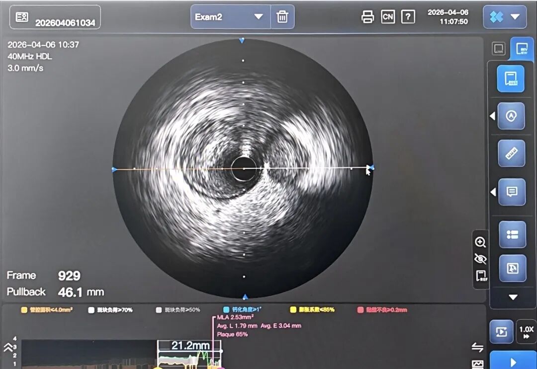 造影导丝是什么如何用“化身导丝”的理念去理解和实现 IVUS-造影配准？_https://www.jmylbn.com_新闻资讯_第4张