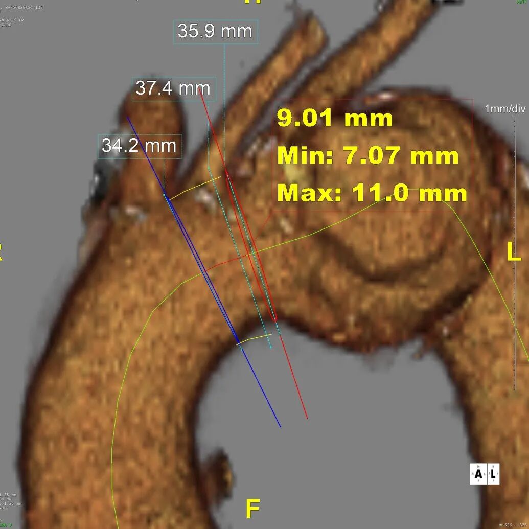 gore医疗怎么样「胸有乾坤」千钧一发 转危为安——Gore TBE治疗急诊破裂TAA一例_https://www.jmylbn.com_新闻资讯_第11张