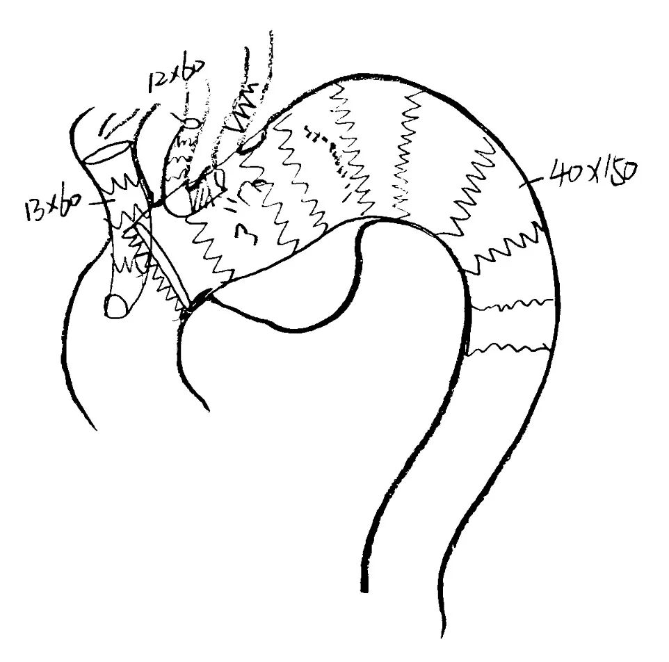 gore医疗怎么样「胸有乾坤」千钧一发 转危为安——Gore TBE治疗急诊破裂TAA一例_https://www.jmylbn.com_新闻资讯_第12张