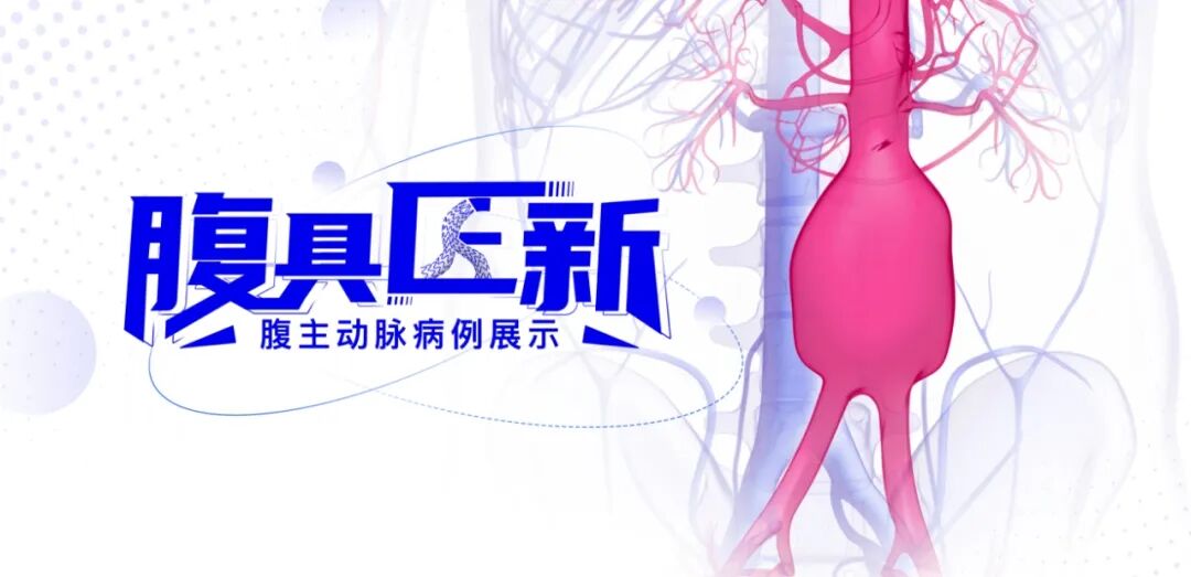 单猪尾支架怎么放【腹具匠新】吴华平教授团队：ENDURANT IIs 分叉支架开窗束径保留 IMA 治疗腹主动脉穿透性溃疡_https://www.jmylbn.com_新闻资讯_第6张