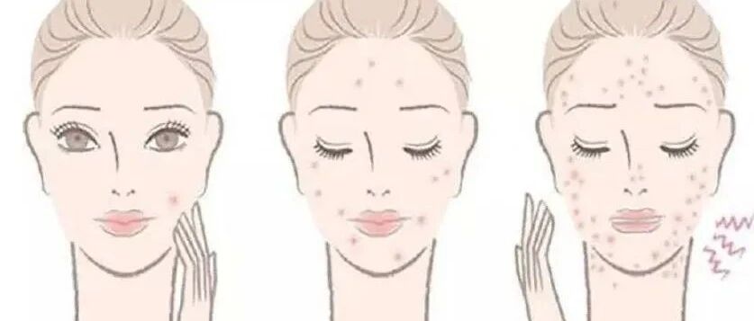 【经验】痘痘频发好难看？几个穴位还您健康皮肤