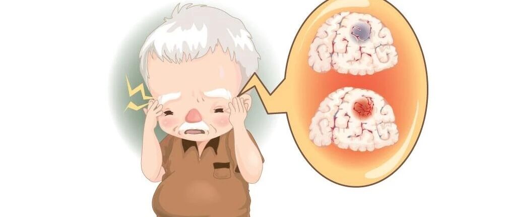 【中医病案】李士懋从湿热论治中风经验