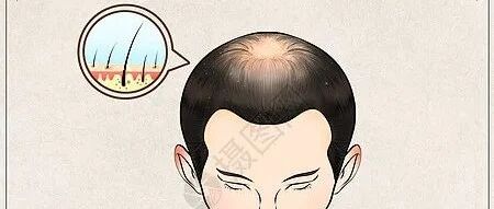 【名医经验】贾育新基于“肺之脾胃虚”治疗脂溢性脱发经验介绍