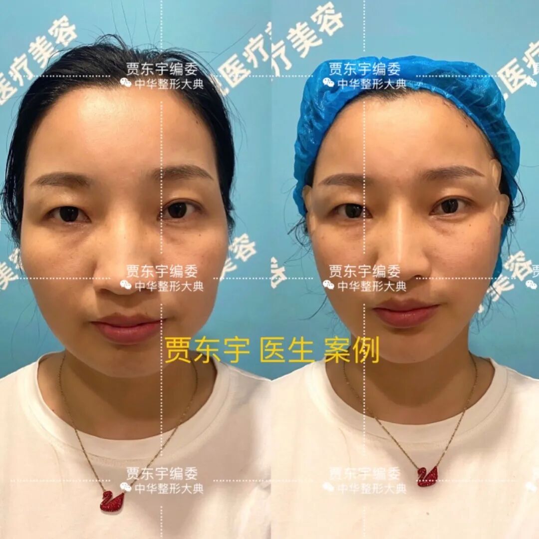 pga和pgla有什么区别贾东宇：什么是面部线雕？有什么优势？丨科普篇_https://www.jmylbn.com_新闻资讯_第6张