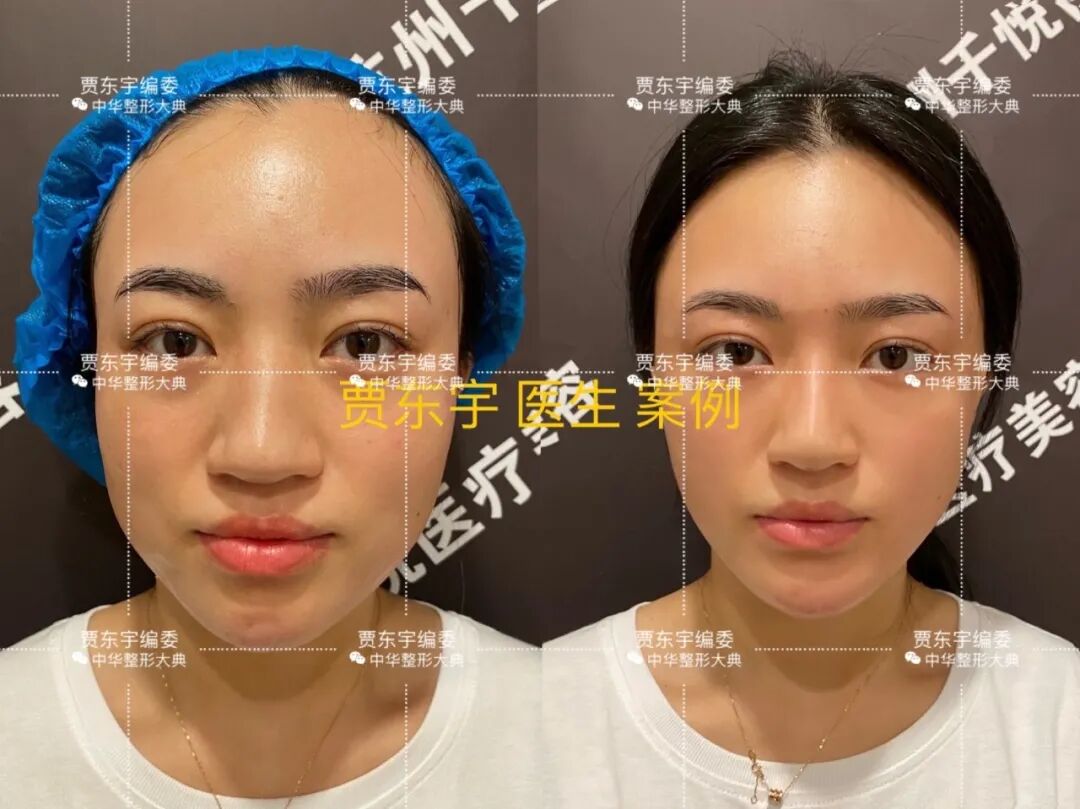 pga和pgla有什么区别贾东宇：什么是面部线雕？有什么优势？丨科普篇_https://www.jmylbn.com_新闻资讯_第7张