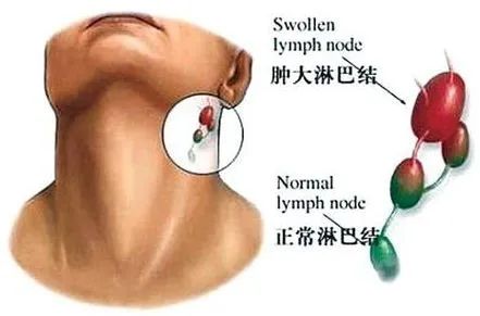 儿童这些淋巴结肿大需引起高度重视