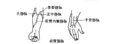 为什么输血不能用小针关于“留置针”的小秘密_https://www.jmylbn.com_新闻资讯_第7张