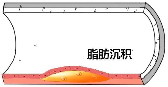 好好的血管，怎麼說堵就堵？ 健康 第10張