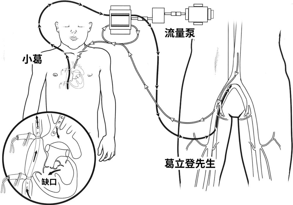 一場死亡風險 200% 的手術， 拯救了千萬心臟病人 健康 第7張