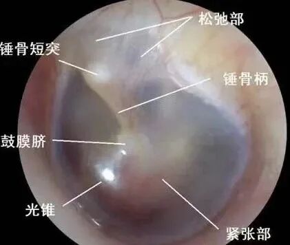 耳朵内窥镜什么样【红旗科普】一文读懂 ｜ 耳内窥镜可以做哪些检查？_https://www.jmylbn.com_新闻资讯_第8张