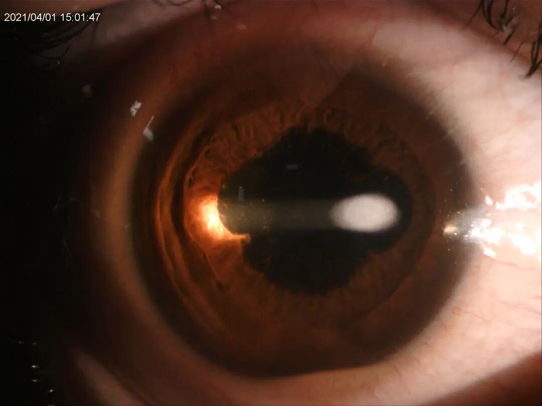 裂隙灯上光源是什么裂隙灯显微镜常用检查方法_https://www.jmylbn.com_新闻资讯_第9张