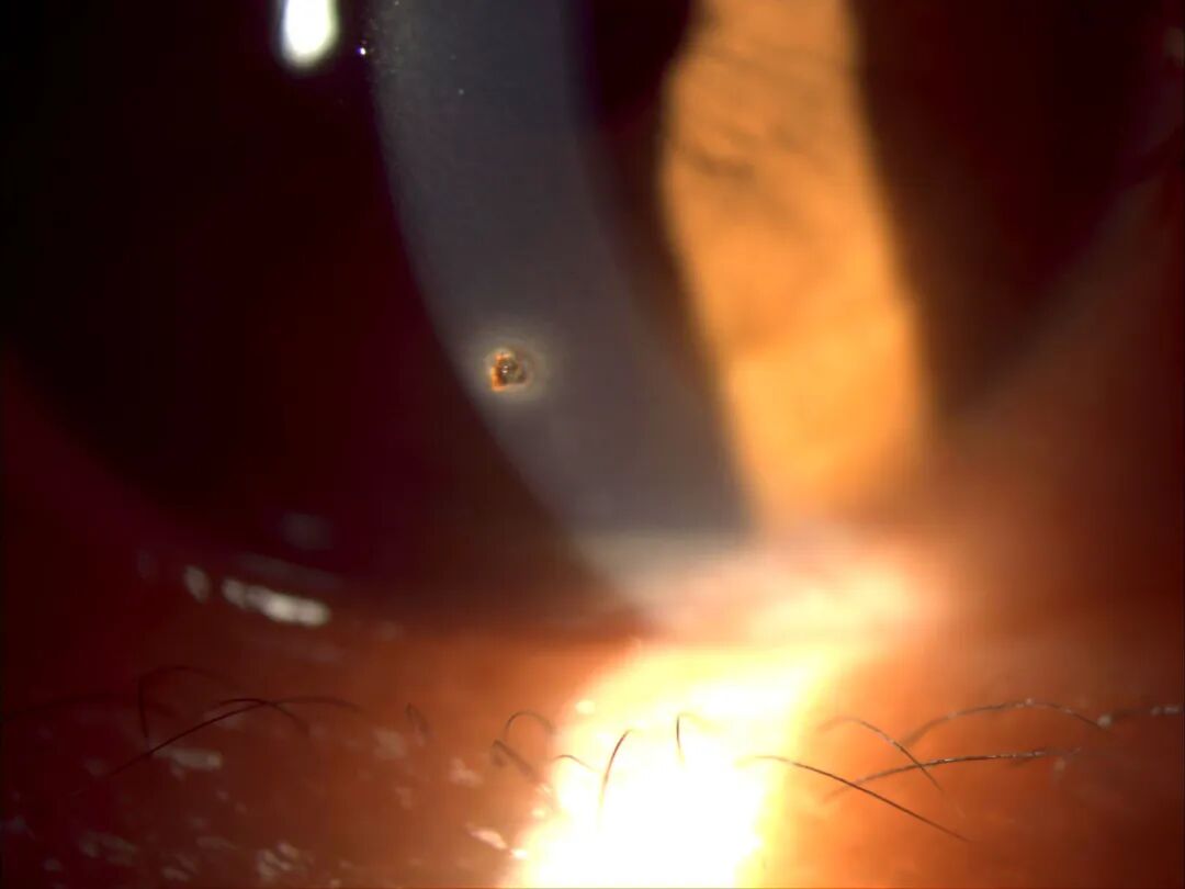 裂隙灯上光源是什么裂隙灯显微镜常用检查方法_https://www.jmylbn.com_新闻资讯_第8张