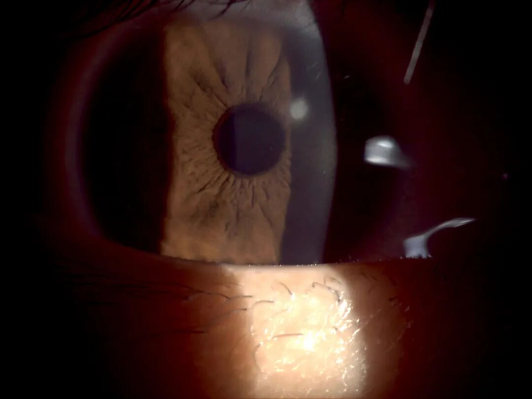 裂隙灯上光源是什么裂隙灯显微镜常用检查方法_https://www.jmylbn.com_新闻资讯_第7张