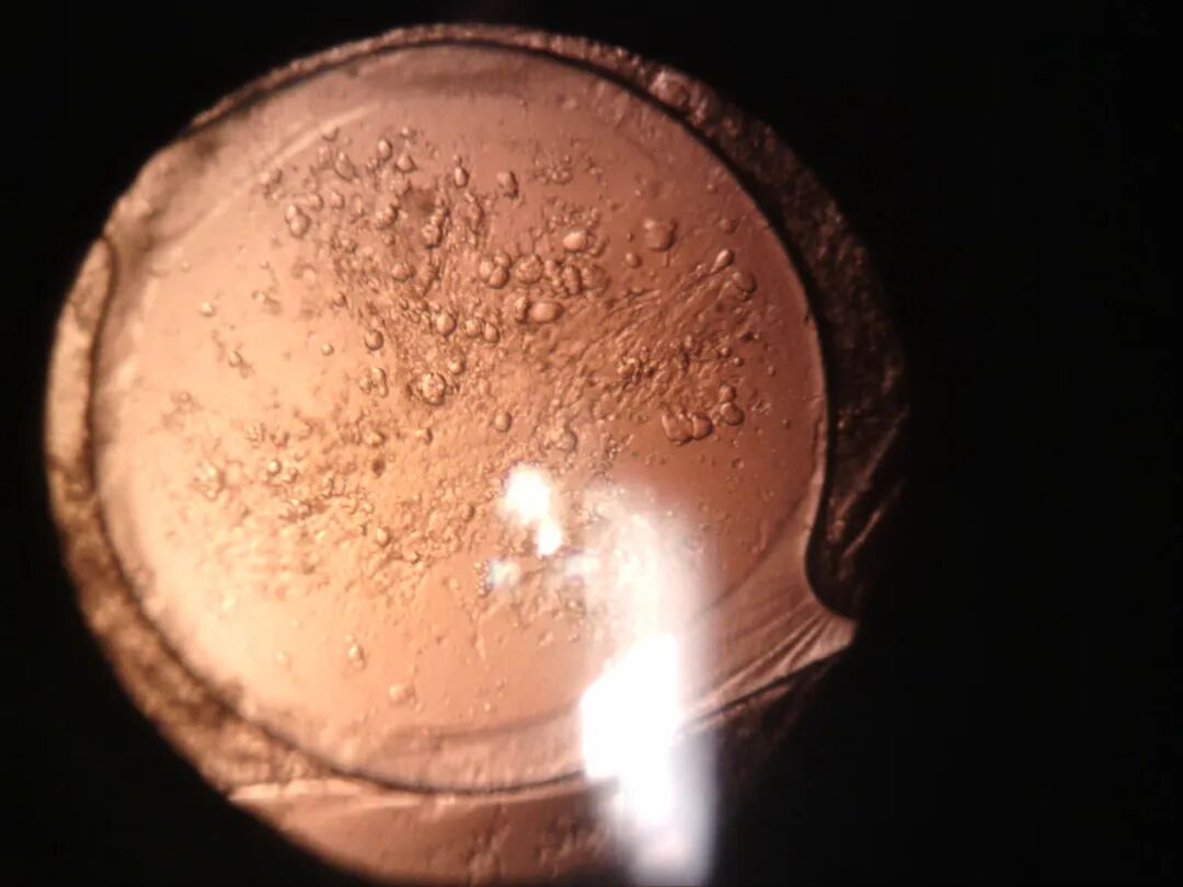 裂隙灯上光源是什么裂隙灯显微镜常用检查方法_https://www.jmylbn.com_新闻资讯_第14张