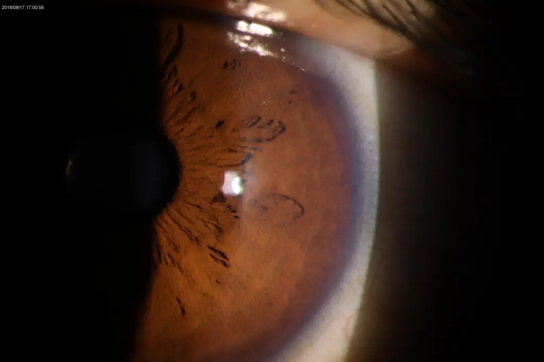 裂隙灯上光源是什么裂隙灯显微镜常用检查方法_https://www.jmylbn.com_新闻资讯_第6张