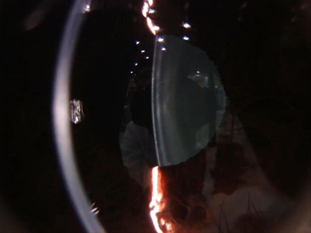 裂隙灯上光源是什么裂隙灯显微镜常用检查方法_https://www.jmylbn.com_新闻资讯_第4张