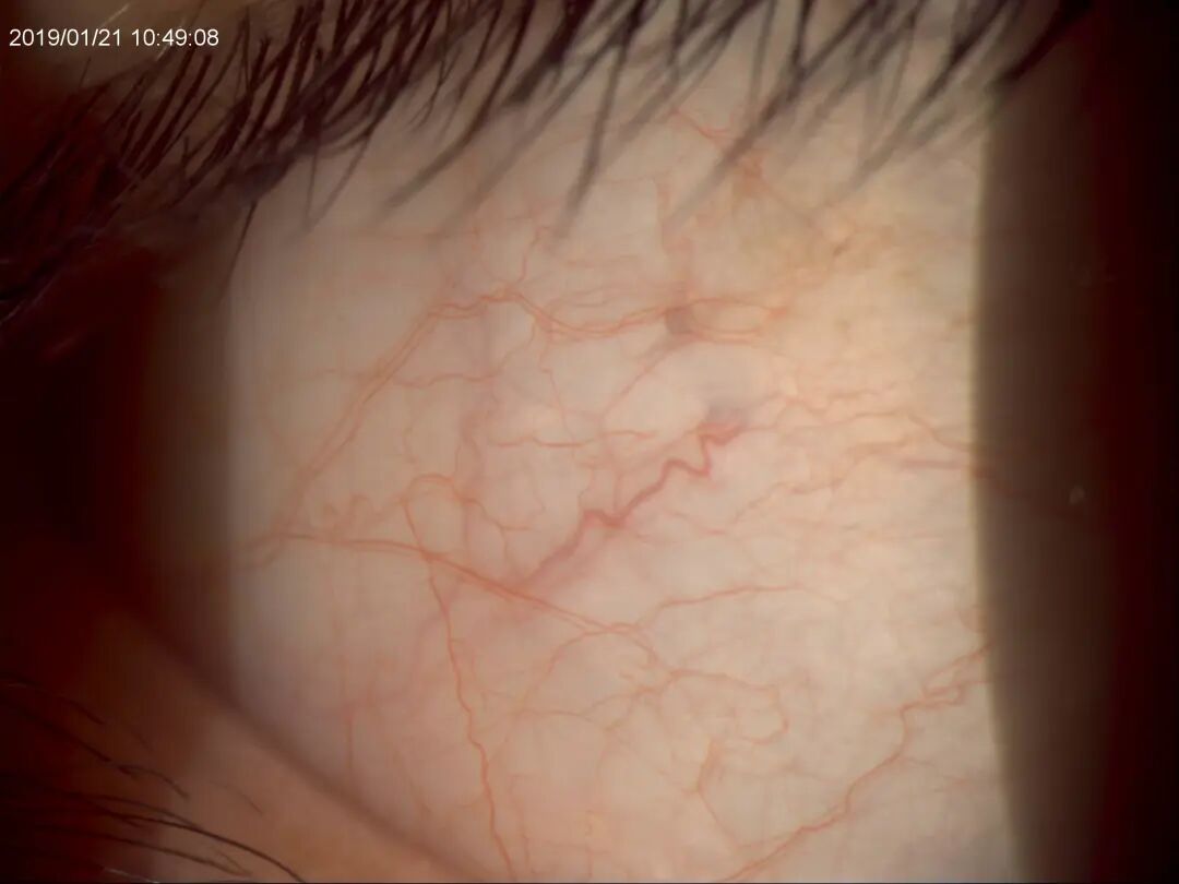 裂隙灯上光源是什么裂隙灯显微镜常用检查方法_https://www.jmylbn.com_新闻资讯_第5张