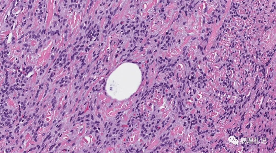 病理视角乳腺浸润性小叶癌