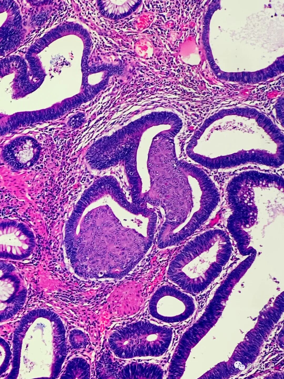 病理视角|管状绒毛状腺瘤的鳞状上皮化生