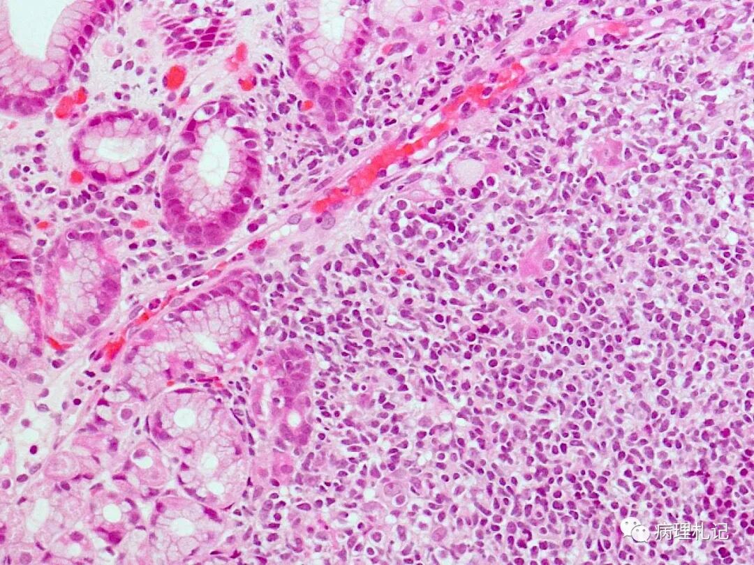 病理视角乳腺浸润性小叶癌