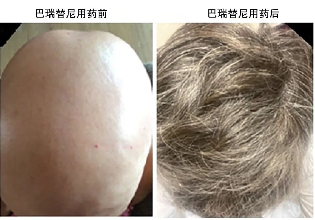 吃类风湿药脱发严重怎么办？（巴瑞替尼治风湿与生发的双重效果）