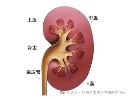 不同位置的肾结石如何快速排出​？