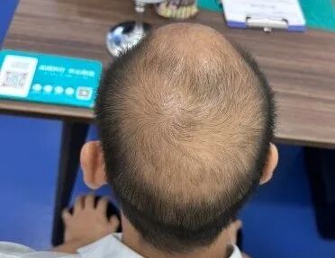 脱发掉发可能是身体在预警，那么身体到底缺什么？