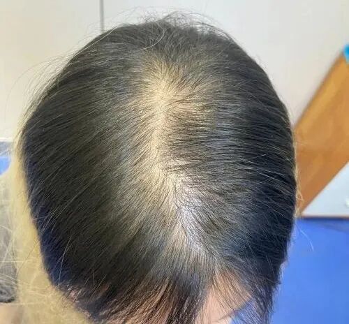 @深圳人，脂溢性脱发的2个前兆，切不可忽视！防脱生发我们要做什么？