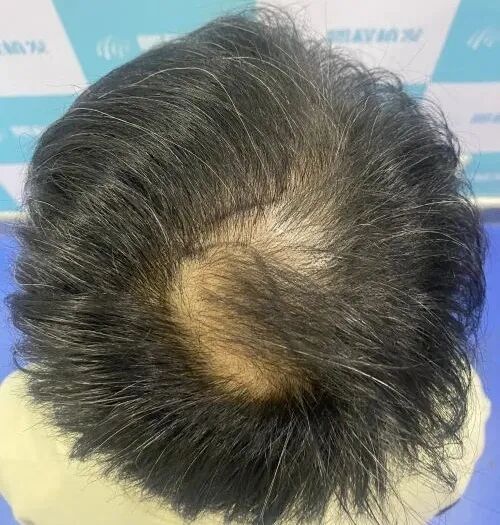 深圳脱发先别焦虑，这些脱发必知事项要牢记！少走好多坑！