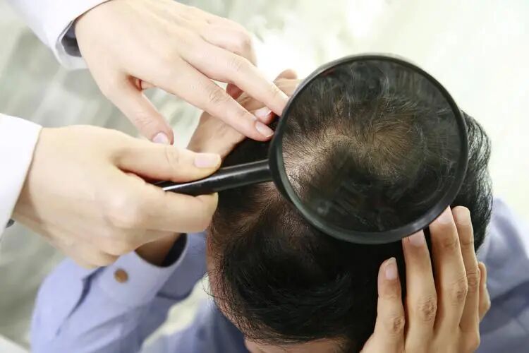 深圳看脱发应该去医院看什么科？脱发严重怎么治疗？
