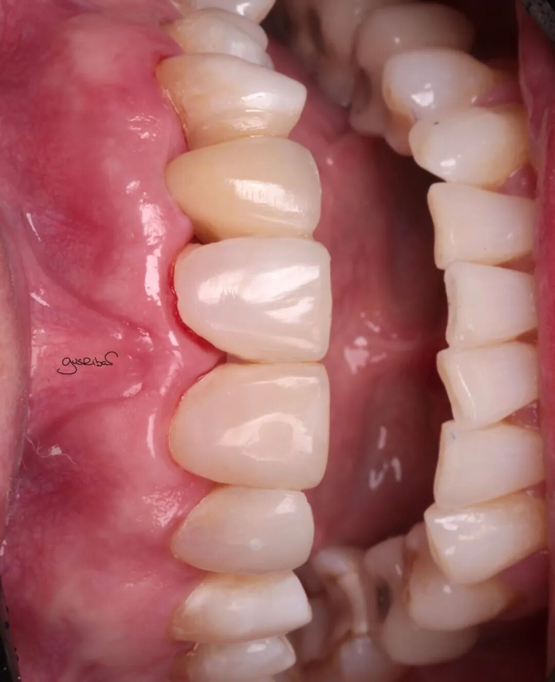 看个马里兰桥修复，感觉好复杂