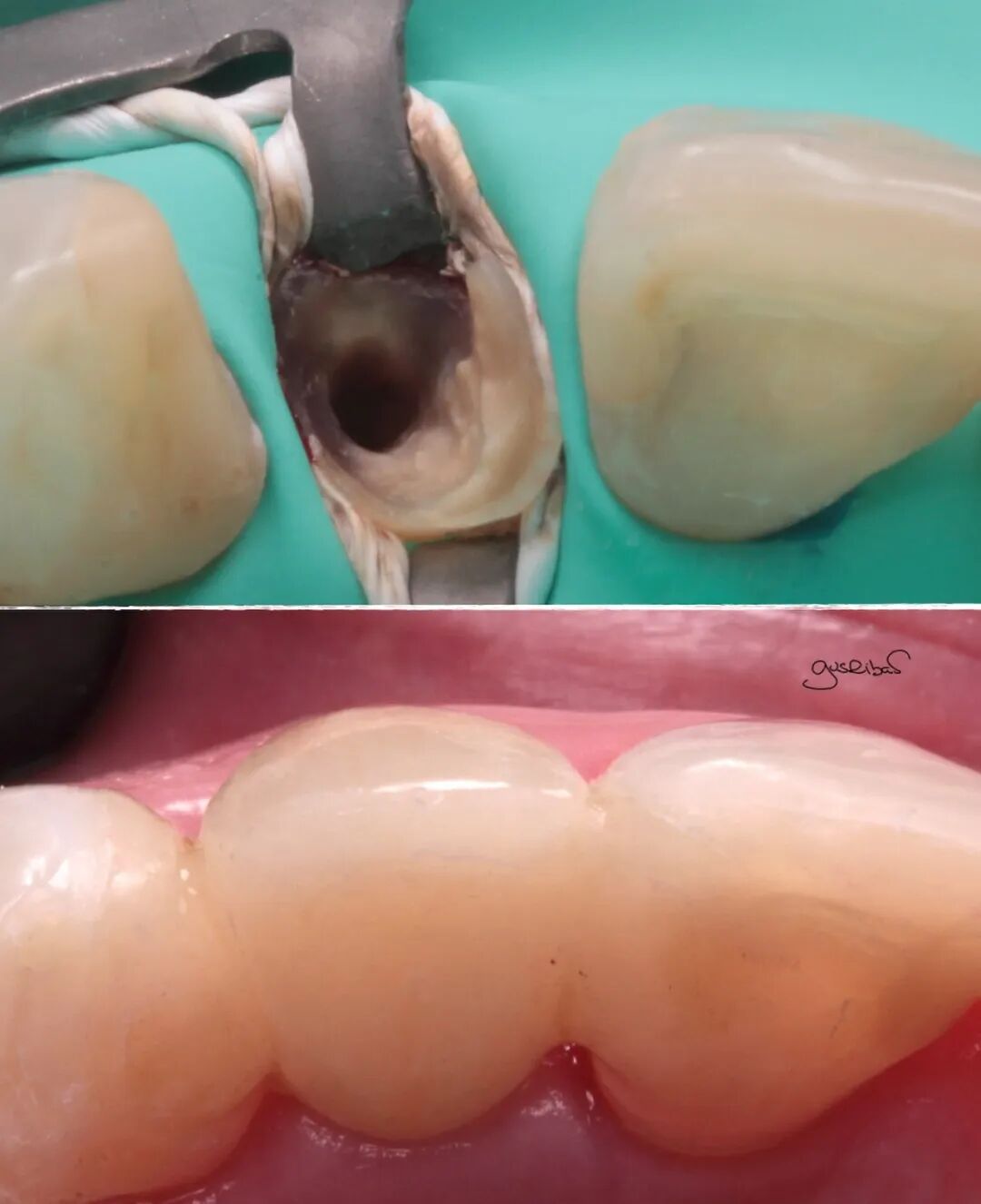 看个马里兰桥修复，感觉好复杂