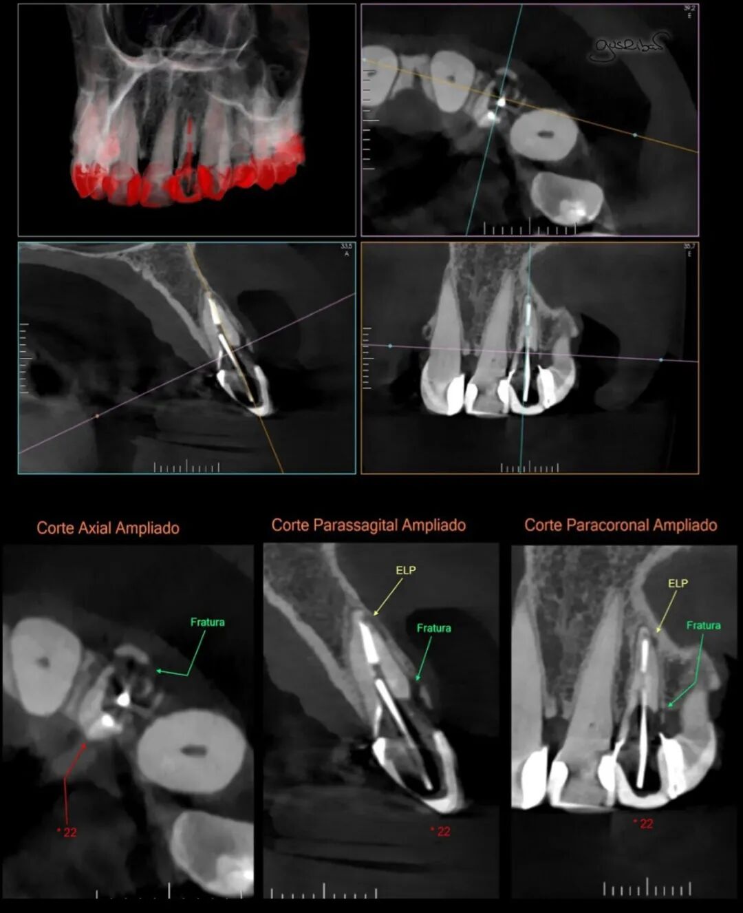 看个马里兰桥修复，感觉好复杂