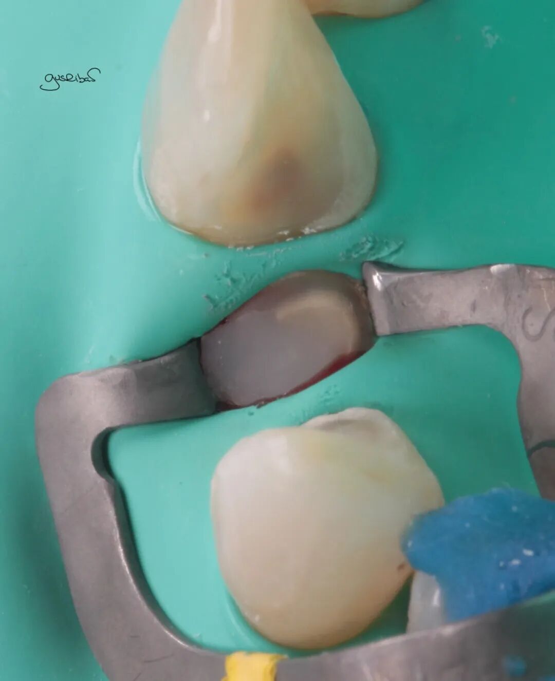 看个马里兰桥修复，感觉好复杂