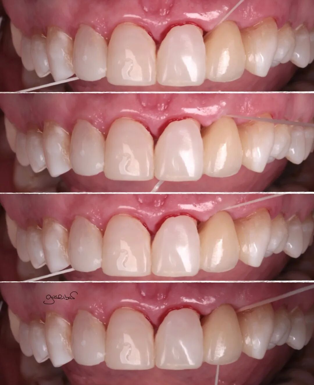 看个马里兰桥修复，感觉好复杂