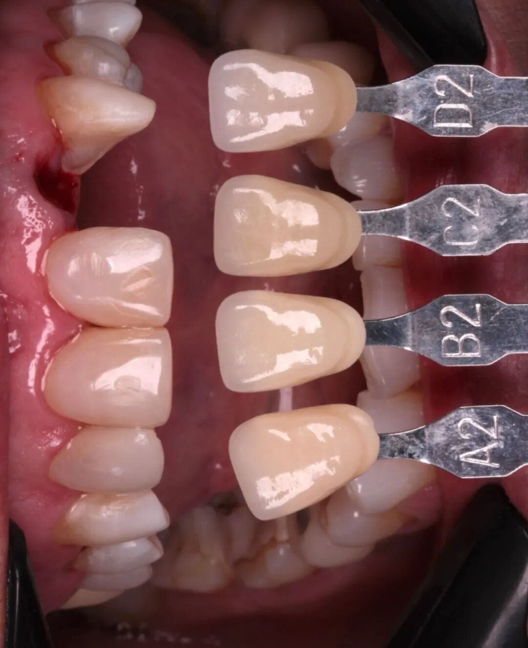 看个马里兰桥修复，感觉好复杂