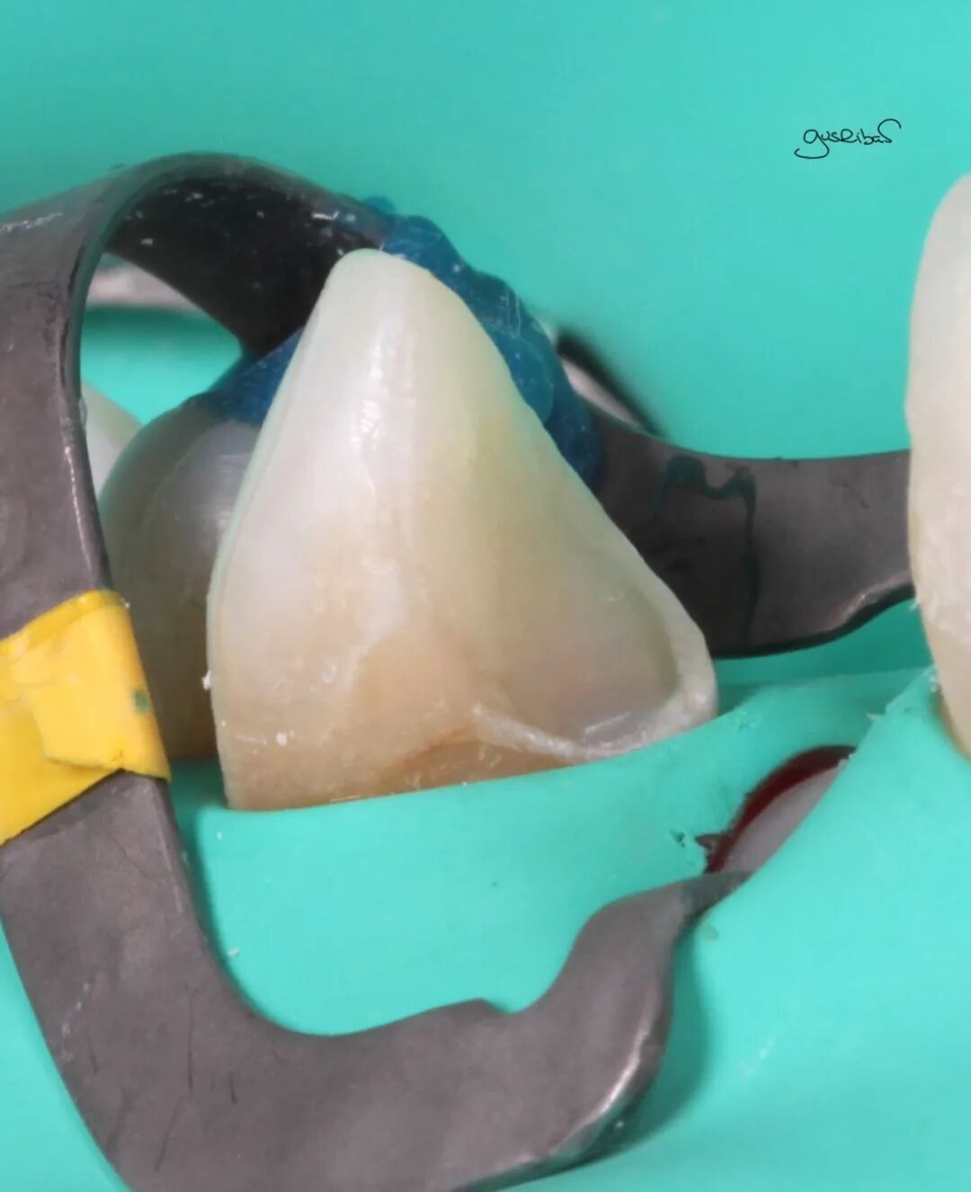 看个马里兰桥修复，感觉好复杂