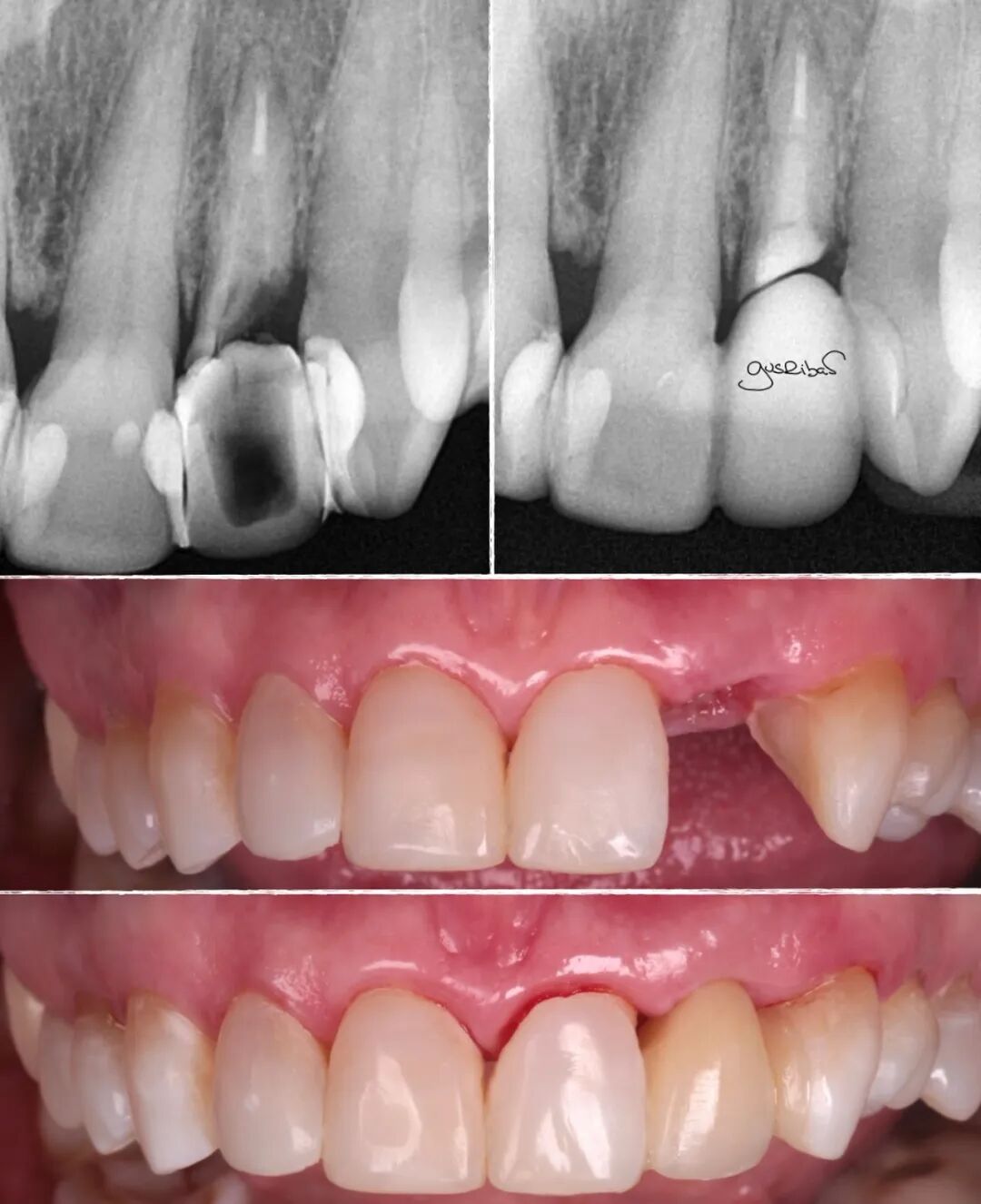看个马里兰桥修复，感觉好复杂