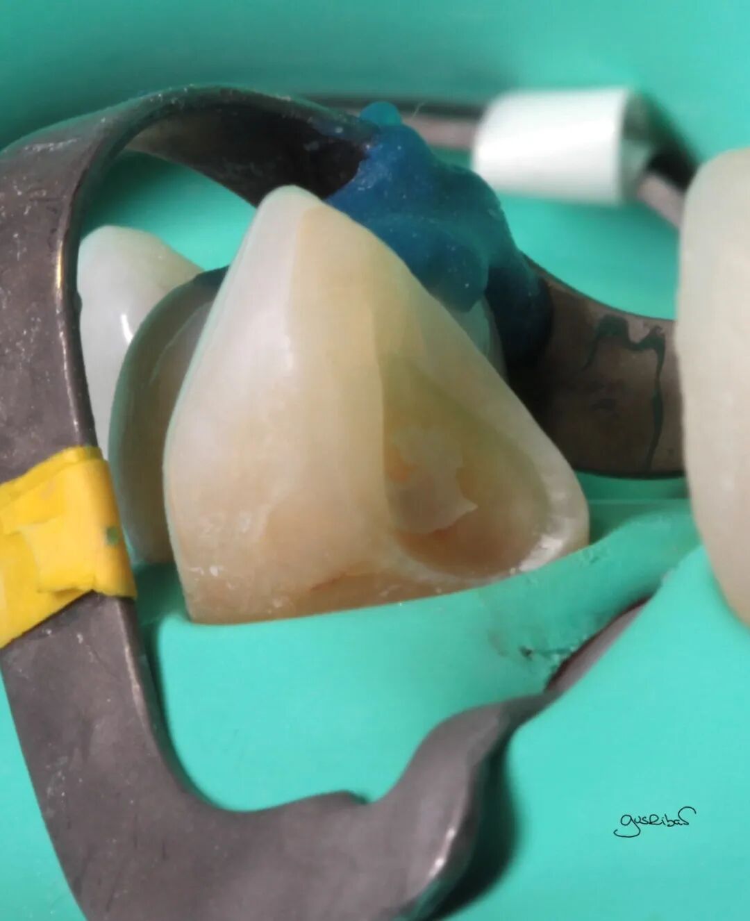 看个马里兰桥修复，感觉好复杂