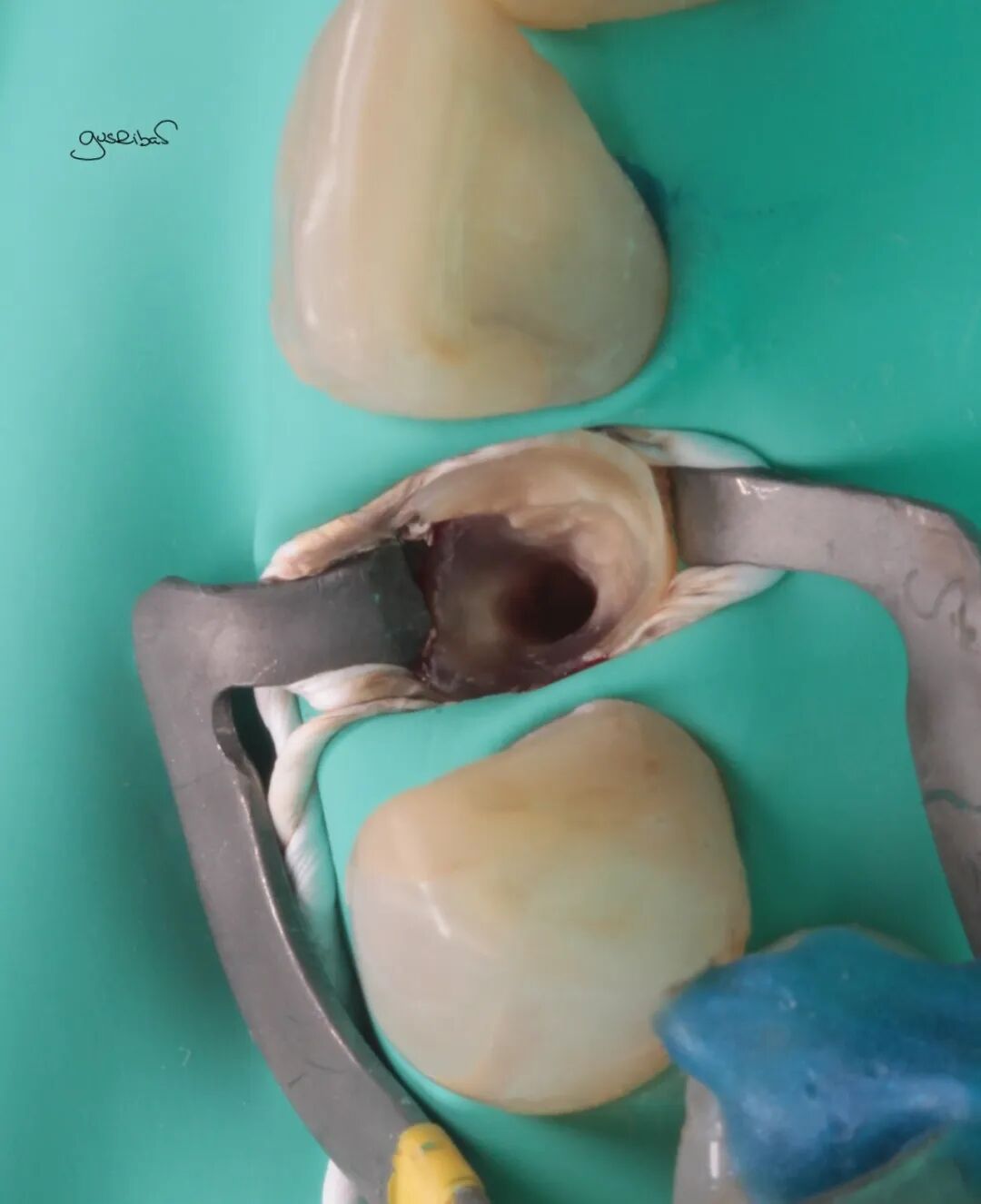 看个马里兰桥修复，感觉好复杂