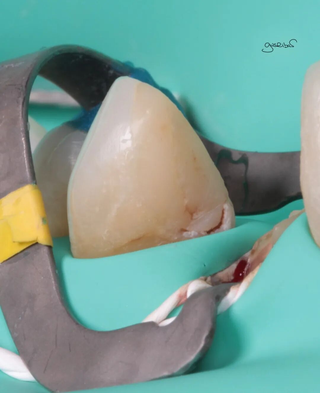 看个马里兰桥修复，感觉好复杂